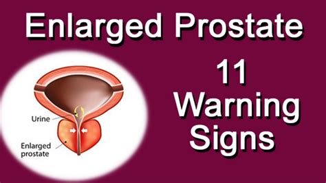 10 Warning Signs You May Have an Enlarged Prostate - Are You at Risk?